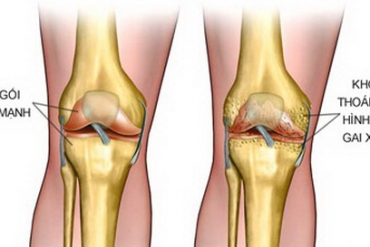 Cách phòng ngừa và điều trị đau khớp khi trời lạnh